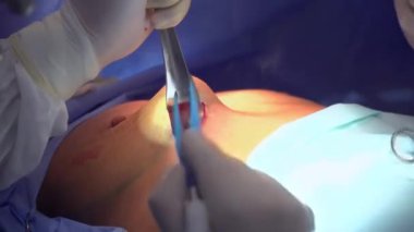 Cerrahi meme büyütme. Bir meme implantı montajı. Ameliyathane cerrahisinde meme büyütme cerrahisi implant aletleri.