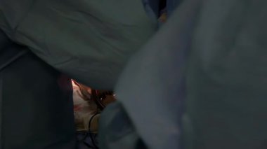 Kardiyak ameliyat. Kalp cerrahları kalbi ameliyat eder. Açık kalp ameliyatı. Bir donörden kalp nakli. Açık göğüs, atan kalp, cerrahi aletler..