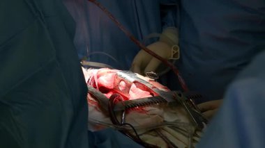 Kardiyak ameliyat. Kalp cerrahları kalbi ameliyat eder. Açık kalp ameliyatı. Bir donörden kalp nakli. Açık göğüs, atan kalp, cerrahi aletler..