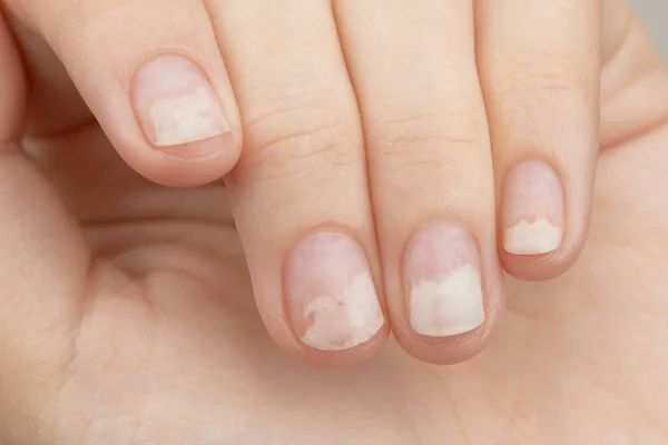 Fingernails with onycholysis after removing gel polish. Womans hands with damaged nails close up
