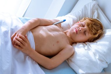 Çıplak gövdede varisella isiliği olan hasta bir çocuktan. Evdeki güneşli yatak odasında yatarken vücut ısısını ölçüyor.