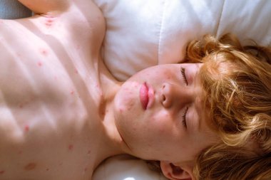 Yüzünde suçiçeği kızarıklığı olan sakin bir çocuk ve gündüzleri yumuşak yastıkta uyuyan çıplak bir gövde.