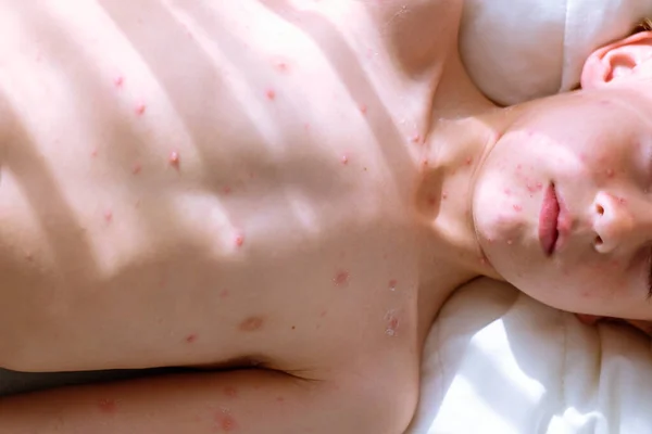 Top View Cop Boy Chickenpox Blisters Naked Torso Lying Bed — Stock Photo, Image