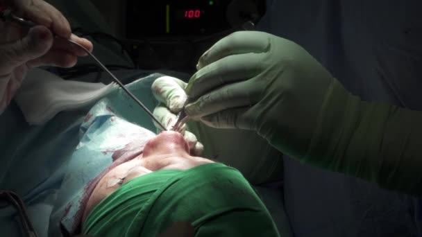 Неузнаваемый Хирург Защитных Перчатках Зашивает Рану Носу Анонимного Пациента Время — стоковое видео