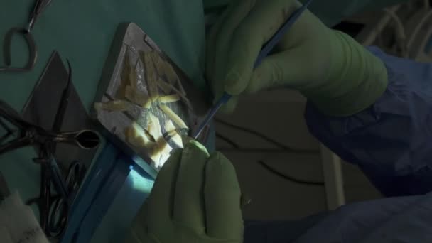 Gesneden Onherkenbare Chirurg Met Scherp Gereedschap Gieten Nasaal Kraakbeen Buurt — Stockvideo
