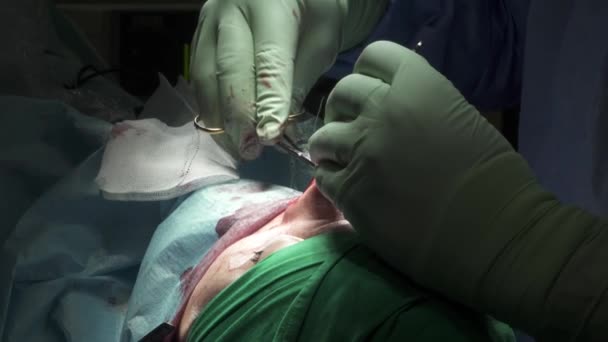 병원에서 코뿔소 수술을 익명의 환자의 상처를 봉합하는 장갑을 수없는 의사를 — 비디오