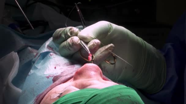 Chirurg Rękawiczkach Ochronnych Zszywający Ranę Nosie Anonimowego Pacjenta Podczas Operacji — Wideo stockowe
