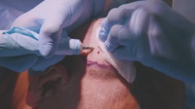 Klinikteki saç nakli sürecinin yakın plan görüntüleri.