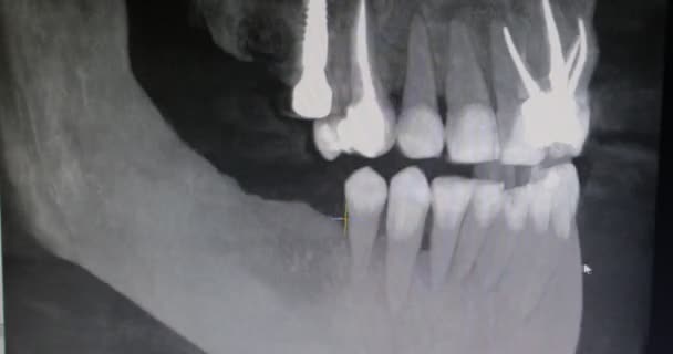 Zbliżenie Rentgenowskie Zębów Pacjenta Ekranie Monitora Klinice Stomatologicznej — Wideo stockowe