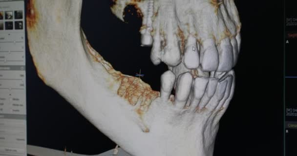 歯のデジタルX線を検査する匿名歯科医の閉鎖歯科クリニックでコンピュータのディスプレイ上で — ストック動画