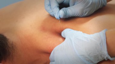 Eldivenli tanınmayan fizyoterapist klinikteki akupunktur seansı sırasında gevşemiş kadın hastanın omzuna iğne batırıyor.