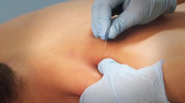 Eldivenli tanınmayan fizyoterapist klinikteki akupunktur seansı sırasında gevşemiş kadın hastanın omzuna iğne batırıyor.