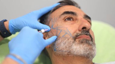 Doktor, kırışıklıkları gidermek için bir güzellik kliniğinde erkek hastanın yüzüne kozmetik enjeksiyon uyguluyor, hastanın yüzü çizgilerle işaretlenmiş, eldiven giyen doktor....