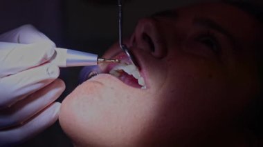 Diş temizleme prosedürünün yakın plan görüntüsü. Bir diş hekimi, diş ve diş etlerini güvence altına almak için hastaya diş temizliği yapmak ve ağız sağlığını korumak için özel diş aletleri kullanır.