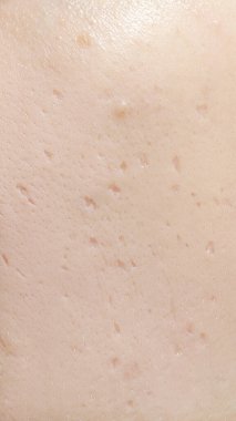 Kadın yüzünün kapanışında deriyle ilgili sorunlar var. Sivilcelerle ve kadın derisinde yara izleri var..