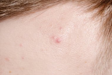 Red pimple on the forehead of a man, close-up clipart