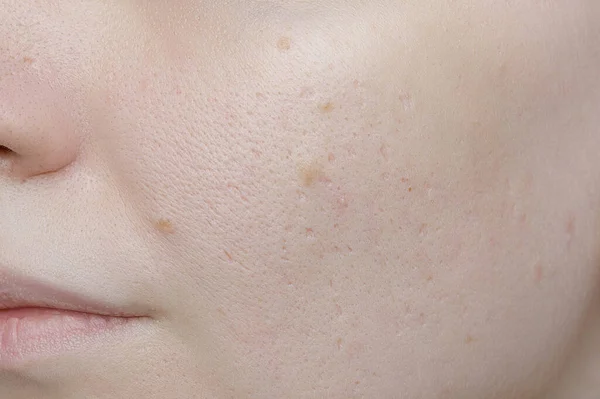 Young woman suffering from problem skin and acne closeup. Icepick scars acne on cheek