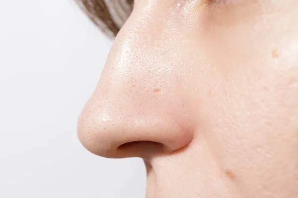 Eine Frau Nase Mit Mitessern Oder Schwarzen Punkten Akne Problem — Stockfoto