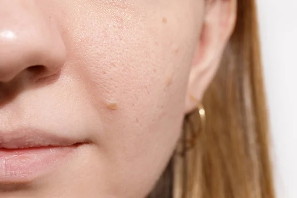 Huidprobleem Met Acne Ziekten Close Vrouw Gezicht Met Droge Lip — Stockfoto