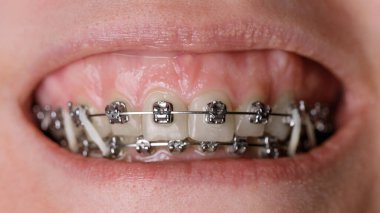 Çarpık dişlerde metal ortodontik diş telleri. Sakız gibi bir gülümseme. Diş konsepti, dişlerin tıbbi hizalanması, parantez ortodontist.