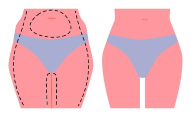 Önce ve sonra liposuction ameliyatı. Kadın popo kaldırma operasyonu. Vücut hatları, yağ azaltma ve estetik geliştirme. Kalça ve karında estetik düzeltme. Tıbbi konsept. Vektör illüstrasyonu