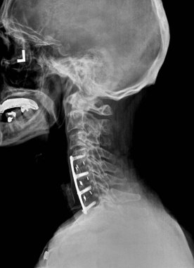 Rahim boynu röntgeni ya da radyografisi. Yan görünüm hastaların boynunu sabitlemek için cerrahi destek gösteriyor.