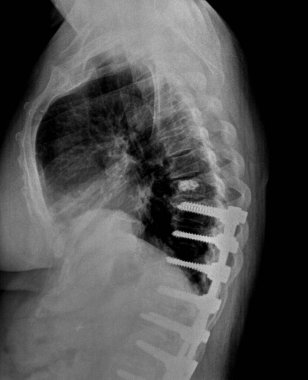 Göğüs omurunun ortasındaki röntgen ya da radyografisi. Yan görünüm hastaları sabitlemek için cerrahi destek gösteriyor.