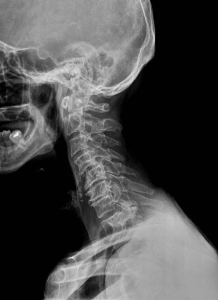 Film x ray or radiograph of a cervical neck in an elderly patient. Lateral side view showing straightening or slight kyphosis normally seen after a whiplash injury with severe degeneration throughout.