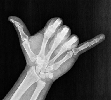 Film xray x-ray or radiograph of hand and fingers showing skelton bones doing shaka sometimes known as hang loose is a gesture with friendly intent often associated with Hawaii aloha and surf culture clipart