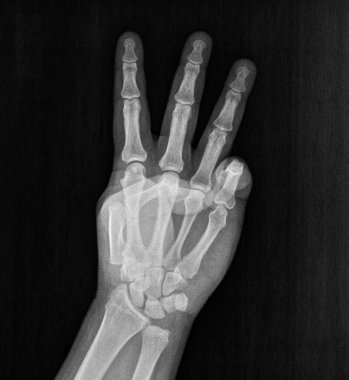 Film xray x-ray or radiograph of a hand and fingers showing the number three 3 in gestural language, manual communication, or signing aka sign language clipart