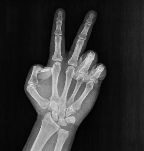 Film xray x-ray or radiograph of a hand and fingers showing the number two 2 in gestural language, manual communication, or signing aka sign language