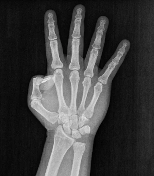 Film xray x-ray or radiograph of a hand and fingers showing the number four 4 in gestural language, manual communication, or signing aka sign language