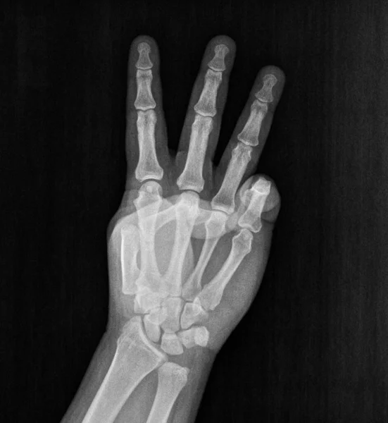 Film xray x-ray or radiograph of a hand and fingers showing the number three 3 in gestural language, manual communication, or signing aka sign language