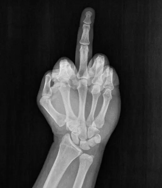Film xray x-ray or radiograph of hand and fingers showing middle finger up obscene gesture of fuck you, fuck off, screw you, fuck yourself, unhappy, pissed off often seen in road rage confrontation
