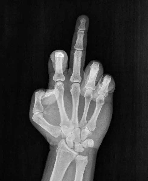 Film xray x-ray or radiograph of hand and fingers showing middle finger up obscene gesture of fuck you, fuck off, screw you, fuck yourself, unhappy, pissed off often seen in road rage confrontation