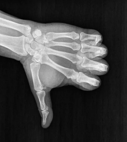 Film xray x-ray or radiograph of a thumb down associated with concern, disapproval, dissatisfaction, rejection and failure in gestural language, manual communication, or signing aka sign language