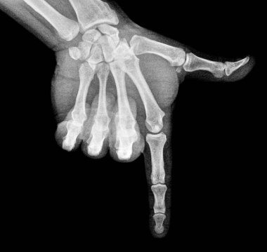 Film xray x-ray or radiograph of a thumb and finger in gestural language, manual communication, or signing aka sign language, pointing this way or that way down or downward downstairs clipart