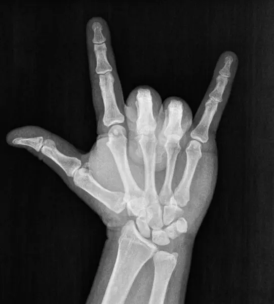 Film xray x-ray or radiograph of hand and fingers showing skeleton bones doing the sign language gesture for I love you with thumb, index and pinky fingers in full extension