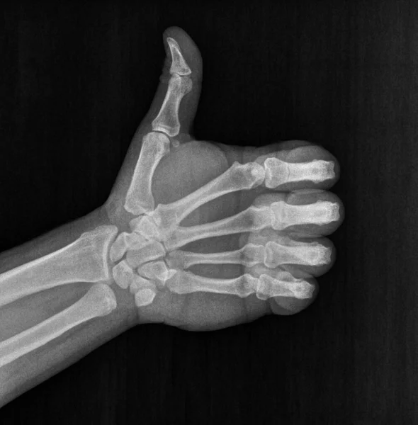 大拇指向上的X光或放射线片 与手势语言 人工交流或手语的同意 确认或阳性有关 图库图片