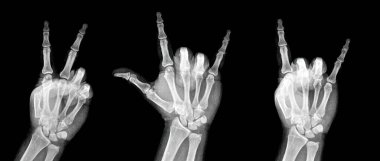 X-ray röntgeni ya da 60 'ların barış sembolünü gösteren el ve parmakların röntgeni ya da V, seni seviyorum, şeytan boynuzu rock. Nam-ı diğer barış, aşk ve rock n roll. beyaz arkaplanda izole