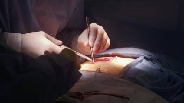 Κοντινό Πλάνο Του Χειρουργείου Επαγγελματικά Χειρουργικά Ράμματα Κομμένα Ιατρικό Κλιπ — Αρχείο Βίντεο