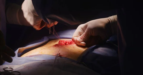 近距离专业外科医生缝线切割 医生在手术室里给病人做手术 护士协助医生 准备和提供医疗器械 在医疗中心工作的医务人员 — 图库照片