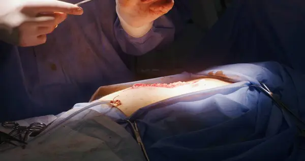Закрыть Операцию Профессиональные Швы Хирурга Вырезать Помощью Клипа Пинцета Молодая — стоковое фото