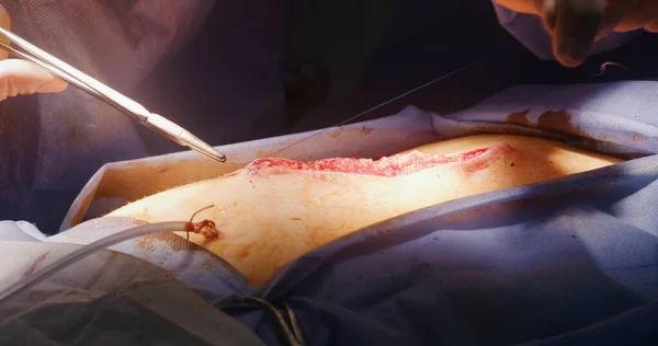 Zblízka Operace Profesionální Chirurgické Stehy Stříhat Pomocí Lékařské Spony Pinzety — Stock fotografie