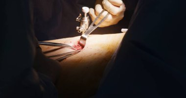 Ameliyat odasında modern laparoskopik aletler kullanarak ameliyat yapan ameliyat kıyafeti giymiş erkek cerrahı kapatın. Profesyonel sağlık görevlileri zor bir ameliyatta meslektaşlarına yardım ediyor. Tıbbi personel iş başında..