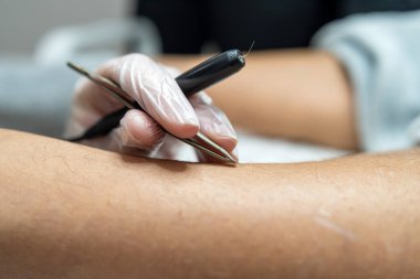 Doktor, tıbbi dolapta kadınların bacaklarından istenmeyen kılların alınması için elektroepilasyon işlemi yapıyor. Sağlıklı yaşam tarzı