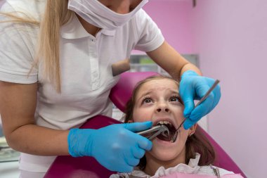 Close-up of a girl with her mouth open looking at the dentist while the doctor checks the child's teeth. A dentist examines children's teeth using a dental examination and a mirror. .