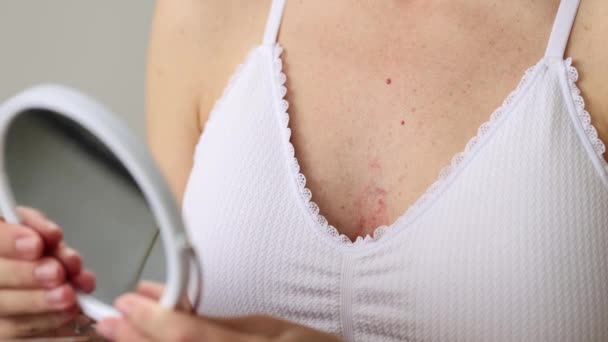 Una Mujer Con Sostén Notó Dermatitis Pecho Imágenes — Vídeos de Stock