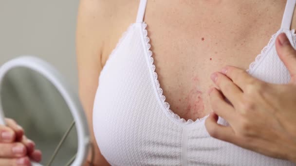 Kvinde Kigger Spejl Bemærket Dermatitis Hendes Bryst Optagelser – Stock-video