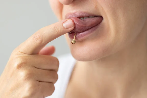 Woman with piercing on the tongue with plaque on the jewellery. Oral care concept